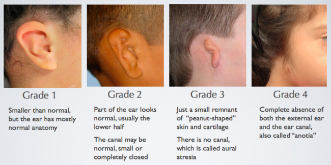 Low-set ears and pinna abnormalities Information