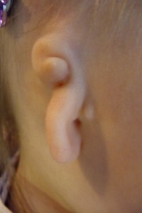 Grade III Microtia and Atresia of the right ear.