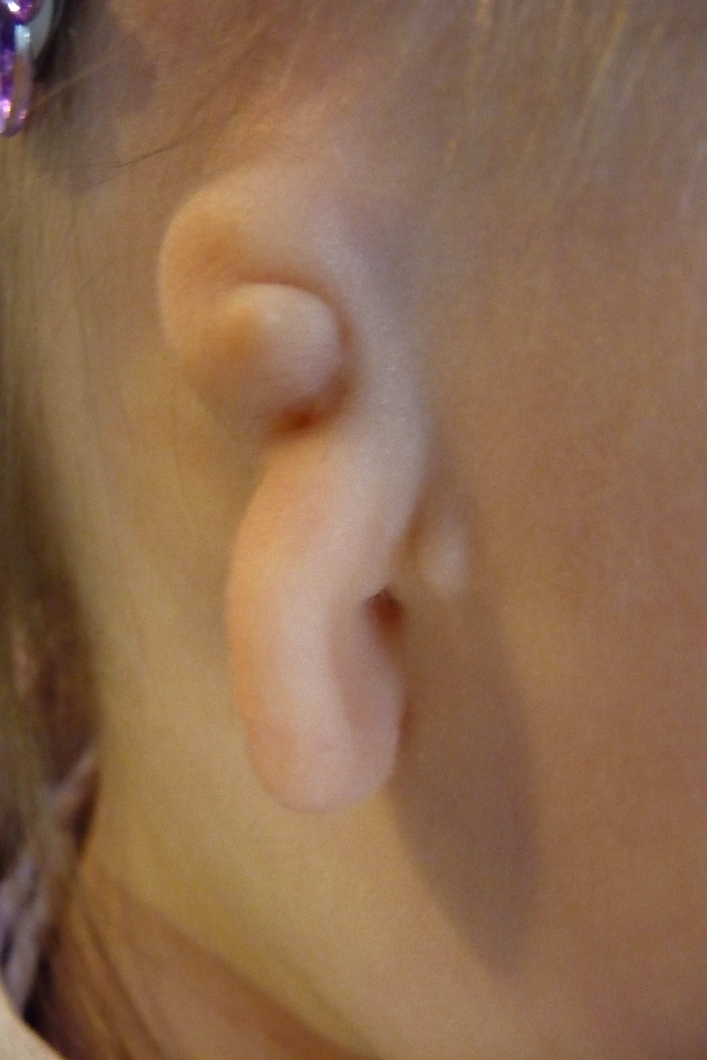 FAQ s About Atresia Ear Community