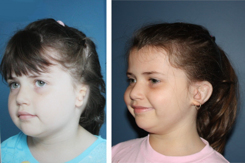 Chelsea, age 5, left ear Microtia/Atresia before and after Medpor with ...