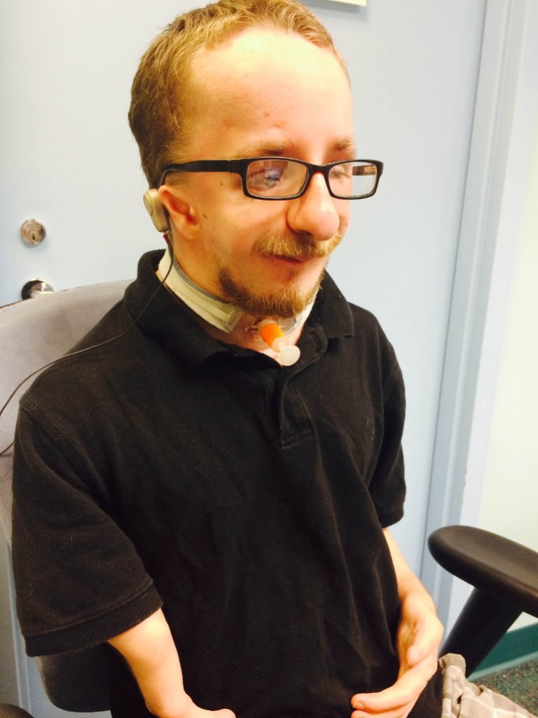 Derek Dwyer, age 22, Bilateral Microtia and Atresia (and Nager Syndrome ...