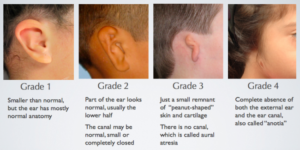 4 grades of microtia and aural atresia